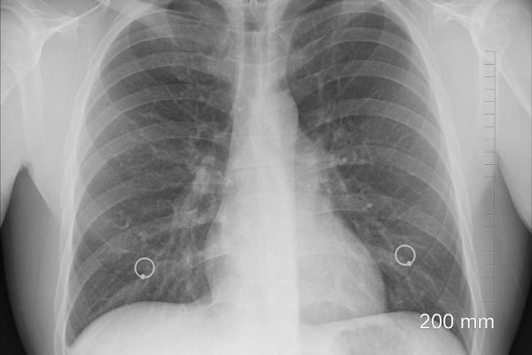 Zaměstnanci Borgersu v Hrádku musí na rentgen, jeden z cizinců má tuberkulózu 