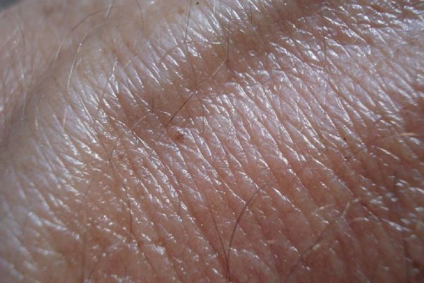 Plzeňští lékaři lépe zjistí rakovinu kůže. Propuknout může i v zimě  
