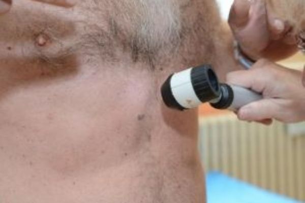 Sokolov: V nemocnici opět upozorní na zhoubný melanom kůže