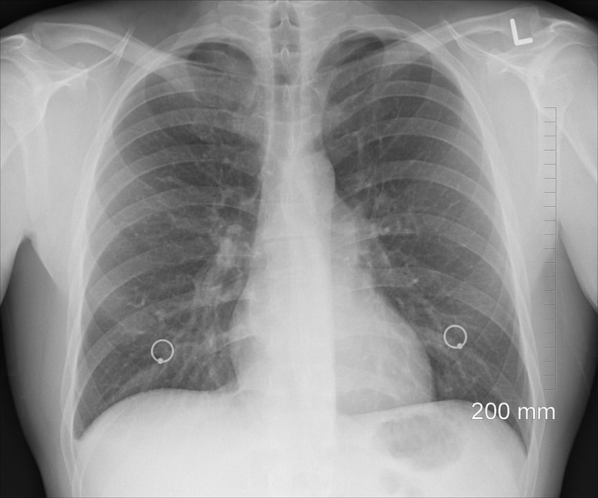 Hygienici z Plzně navrhují testovat zahraniční pracovníky na tuberkulózu